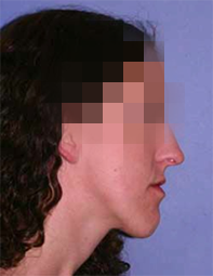 implantes dentales